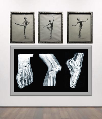 Three framed drawings of a ballet dancer in various dance poses are displayed above a large print resembling X-ray images—two showing individual feet and one showing a knee.  